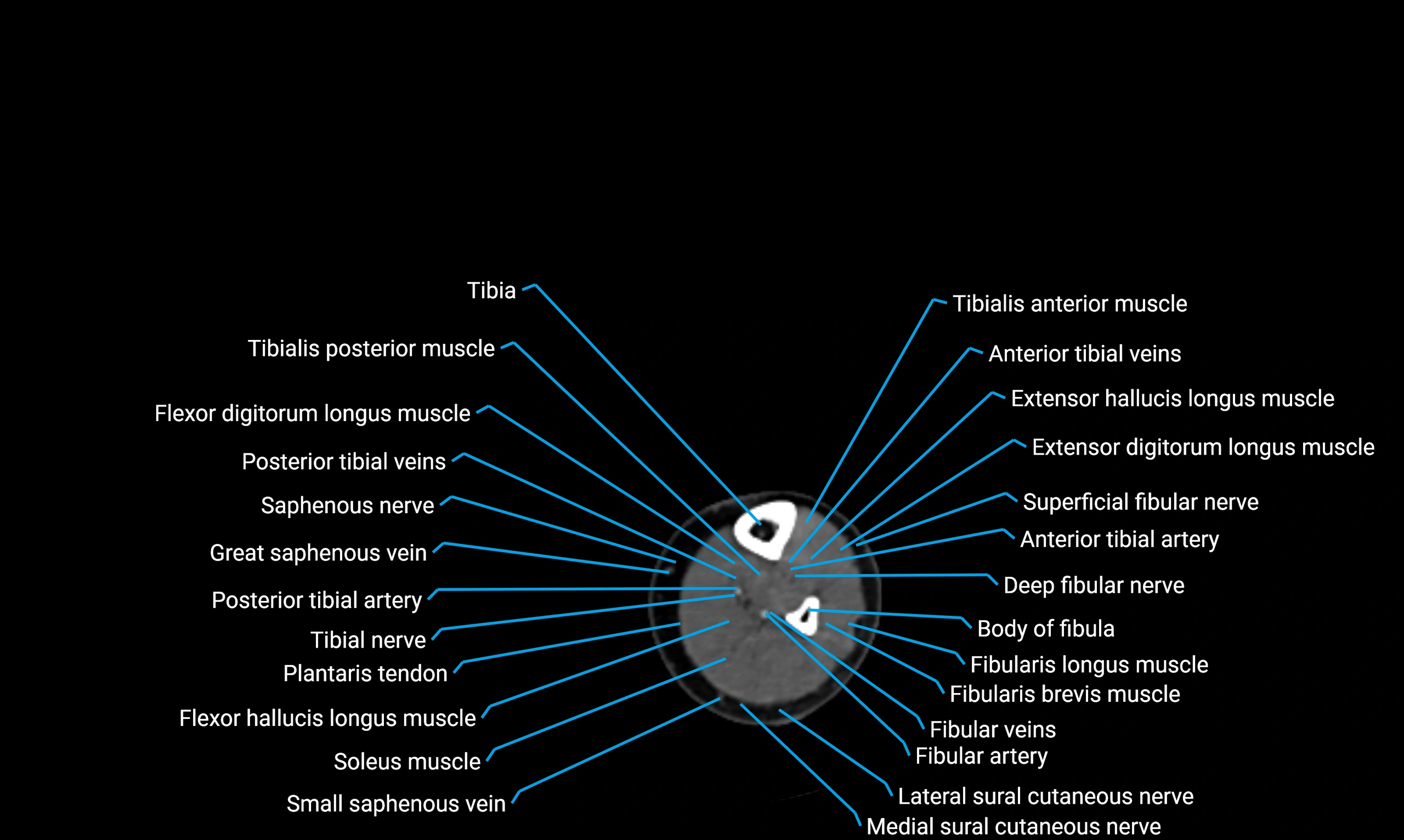 CT lower limb axial cross sectional anatomy labelled image 131 (2).webp